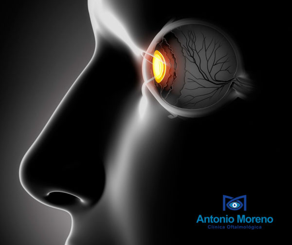 Cirugía para el desprendimiento de retina en Málaga retina Málaga