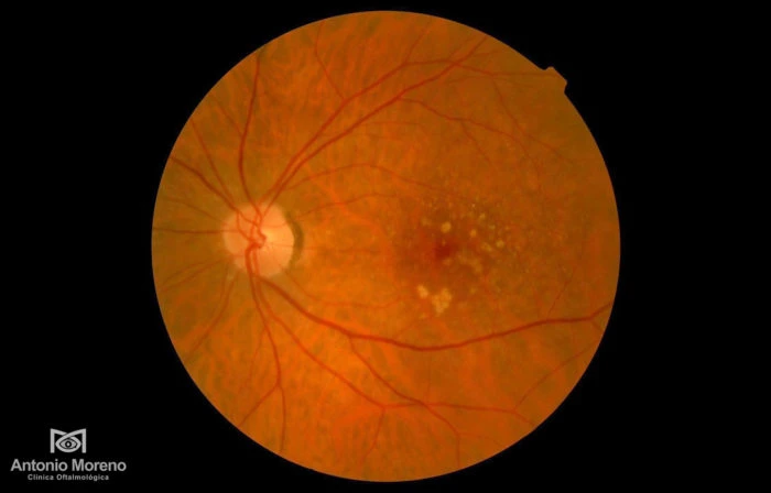 Destellos de luz laterales