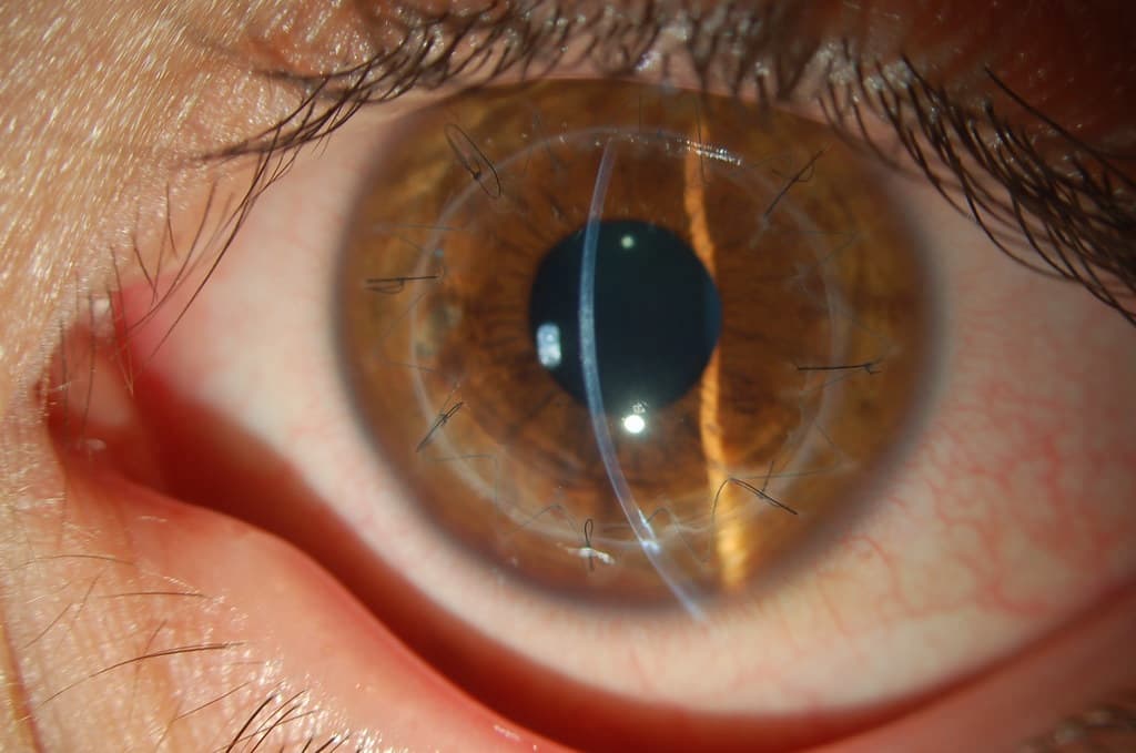 Facoemulsificación de cataratas