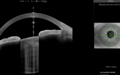 Anterion queratocono