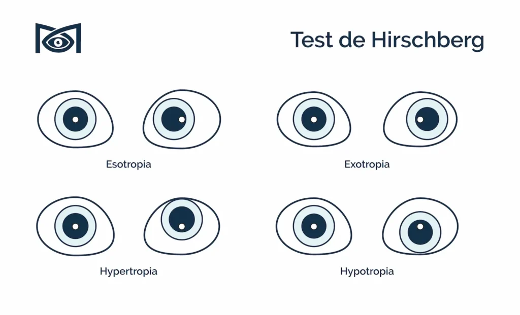 Qué es el Test de Hirschberg