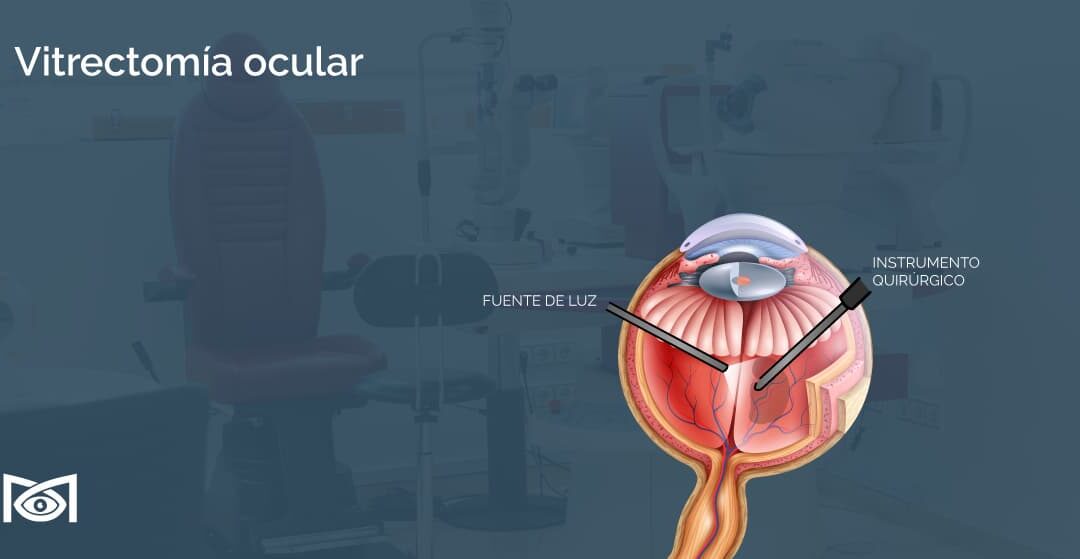 Vitrectomía ocular