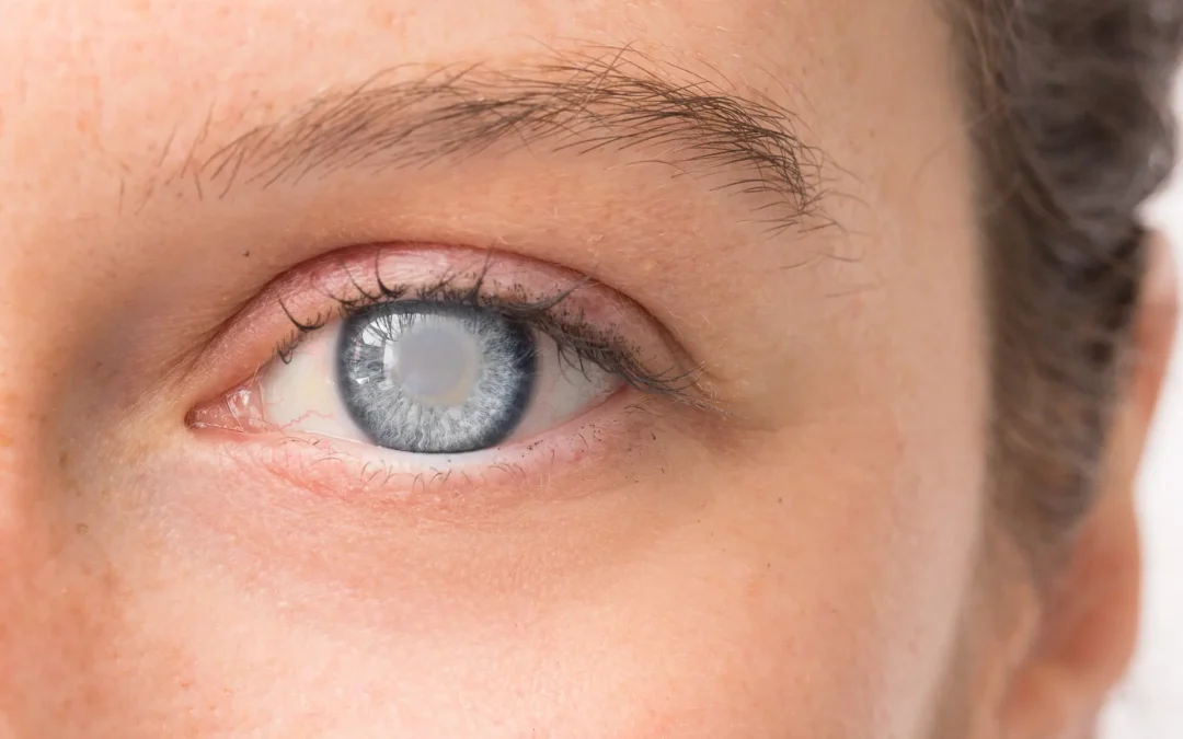 Lensectomía refractiva