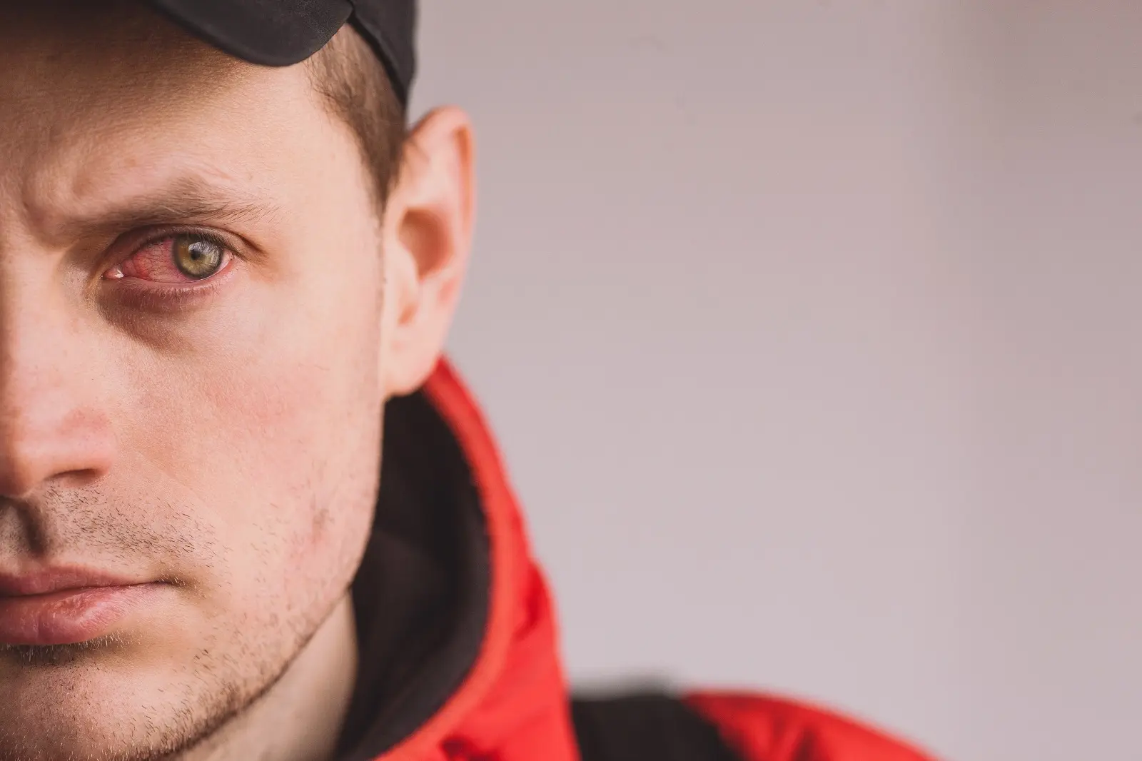 Esclerotica irritada