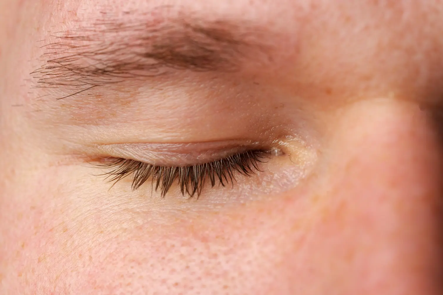 Xantelasma palpebral y señales oculares