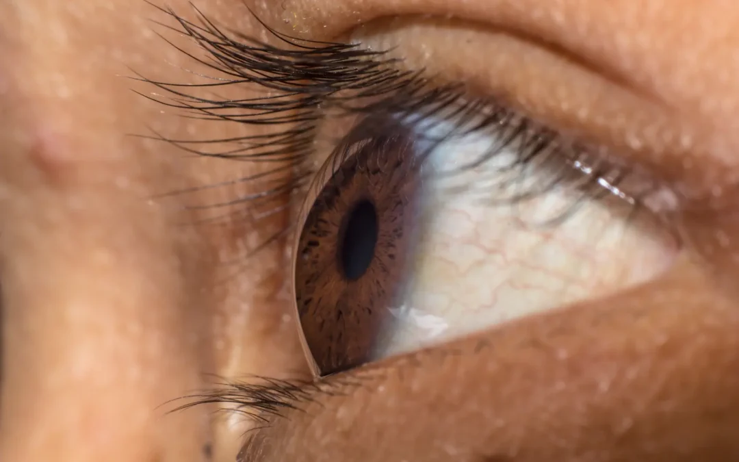 Pterigión del ojo: una carnosidad ocular más común de lo que parece