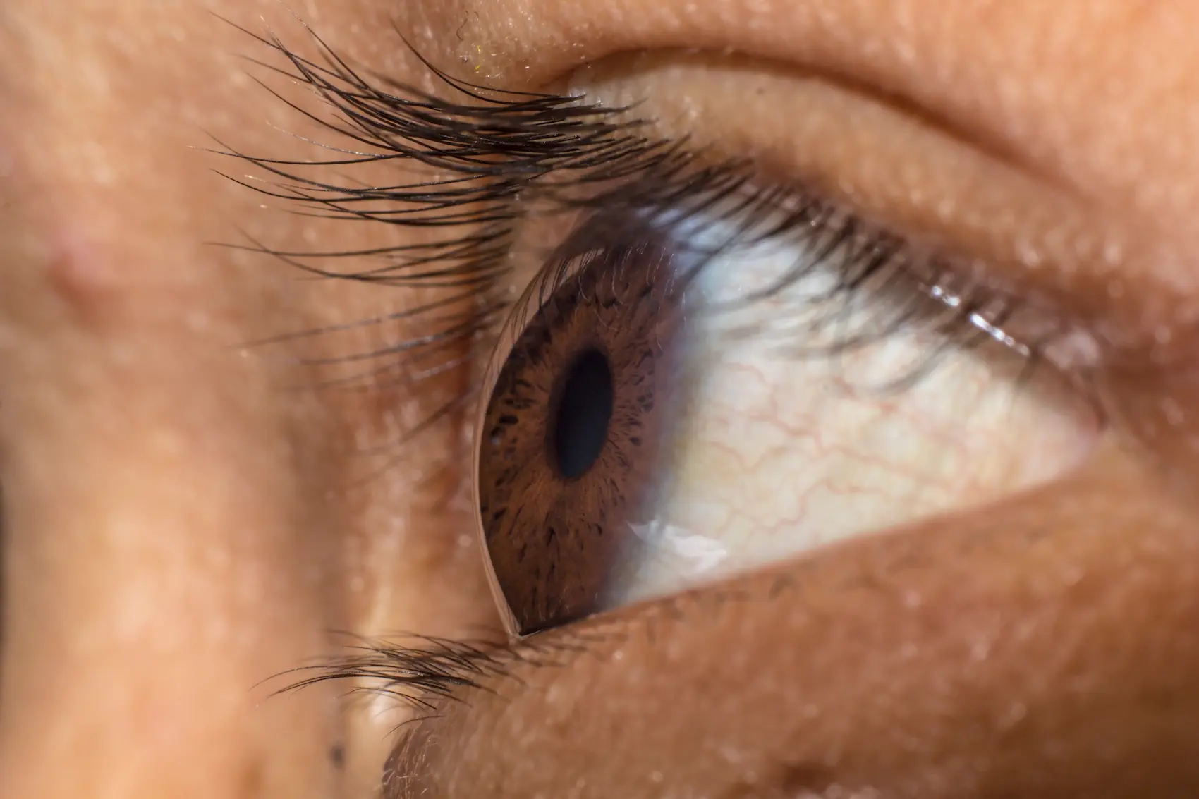 qué es el pterigión del ojo