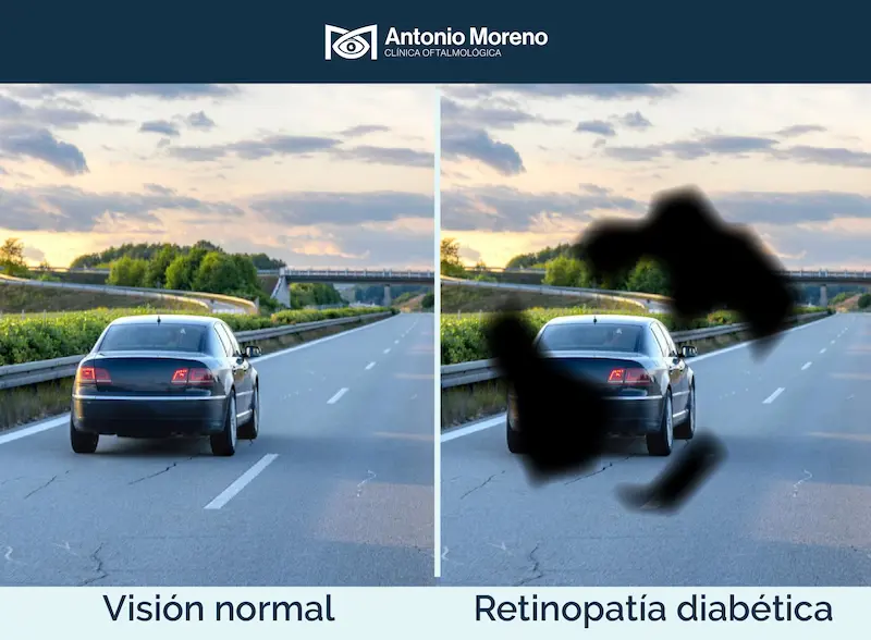 retinopatía diabética retinopatía diabética