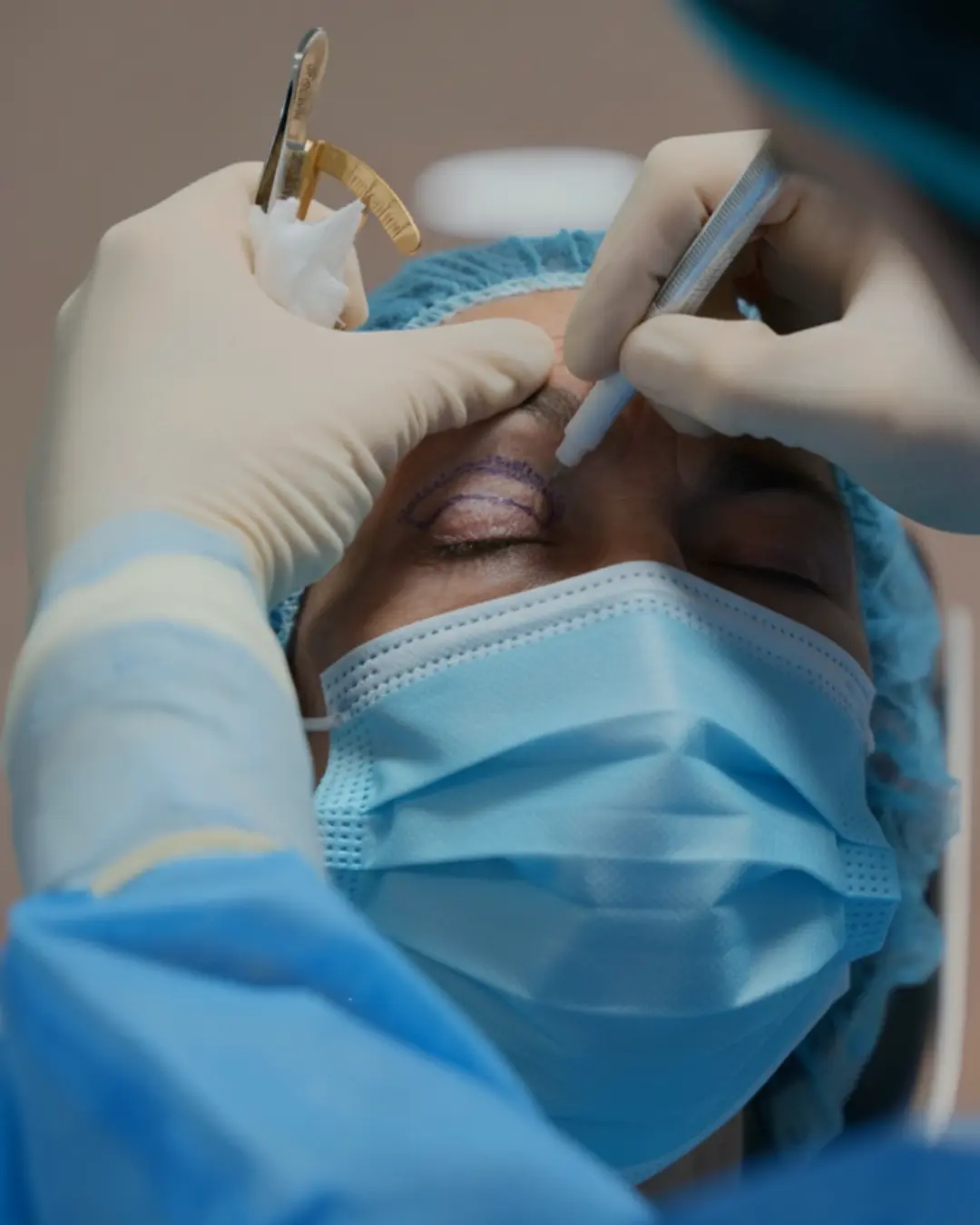 blefaroplastia en málaga blefaroplastia en málaga