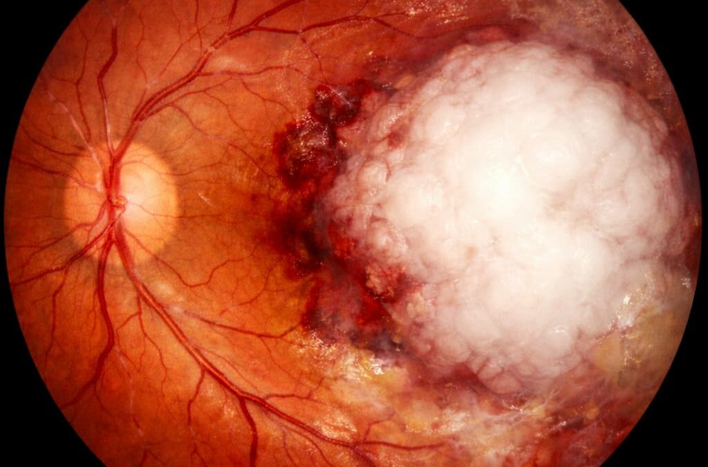 Retinoblastoma: qué es, síntomas, diagnóstico y tratamiento